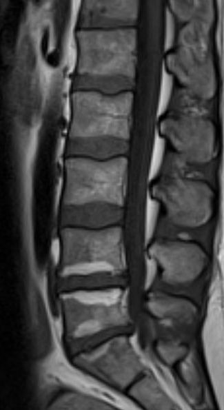 Antibiotic Spine Treatment